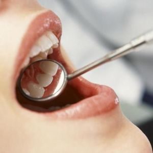 Wax Up стоматология (моделирование)